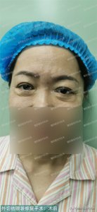 ​眼袋修复 53岁来北京做了外切祛眼袋修复手术，女士说术后效果真的是太好了