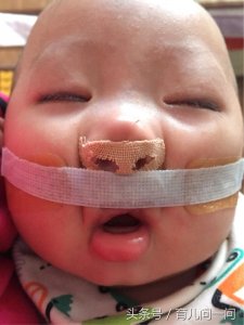 唇腭裂宝宝,变相靓宝一枚!医生都觉得不可思议!
