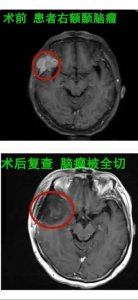 ​头皮长出包块没在意 一查“真身”竟是脑瘤