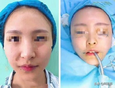 ​大胃王猫妹妹流产手术后做脸脂肪填充整容