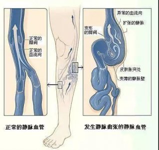 ​关于静脉曲张你知道多少？多图带你深入了解静脉曲张！