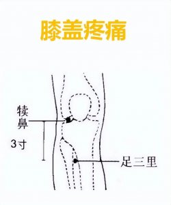 ​古代禁刺的犊鼻穴，现在很多医家却常用针刺，你知道为什么吗？