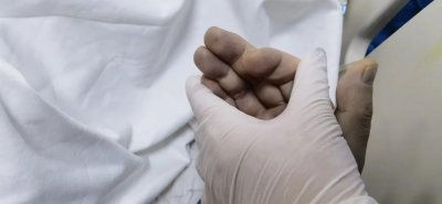 吃变质食品后,男子全身竟变蓝黑色!