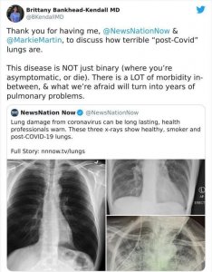 不吸烟、吸烟、感染冠状病毒,三个肺部X光照片,看完我想戒烟了