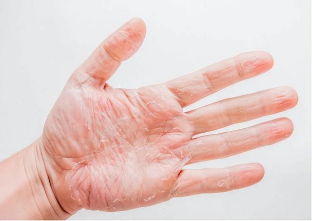 每到换季手脱皮是什么原因（一到换季手就脱皮）(1)