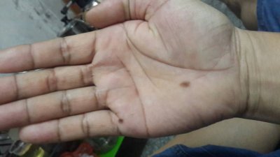 ​男人手掌有痣是好是坏